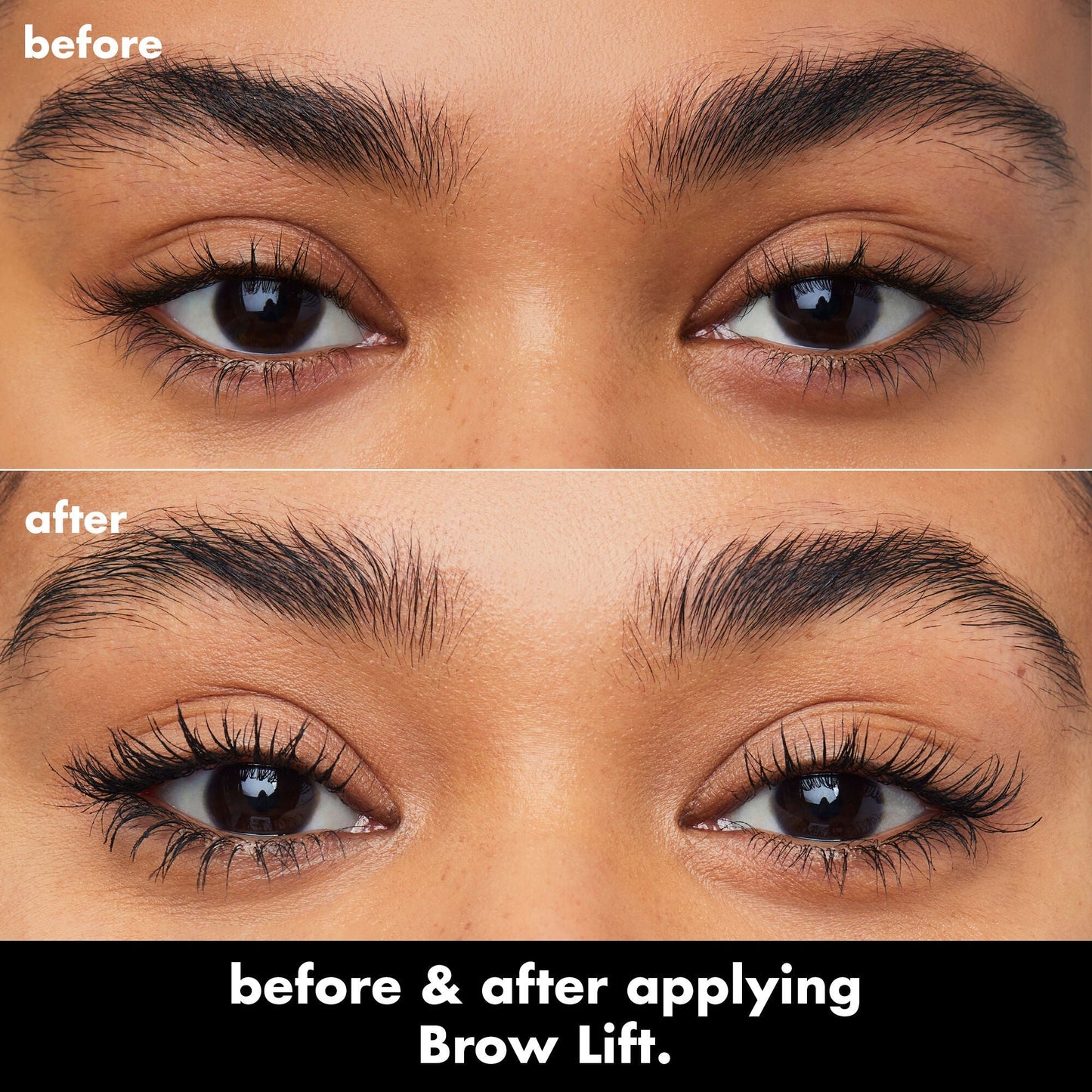 brow-lift-h6 0326_EDU_BrowLift_BA.jpg