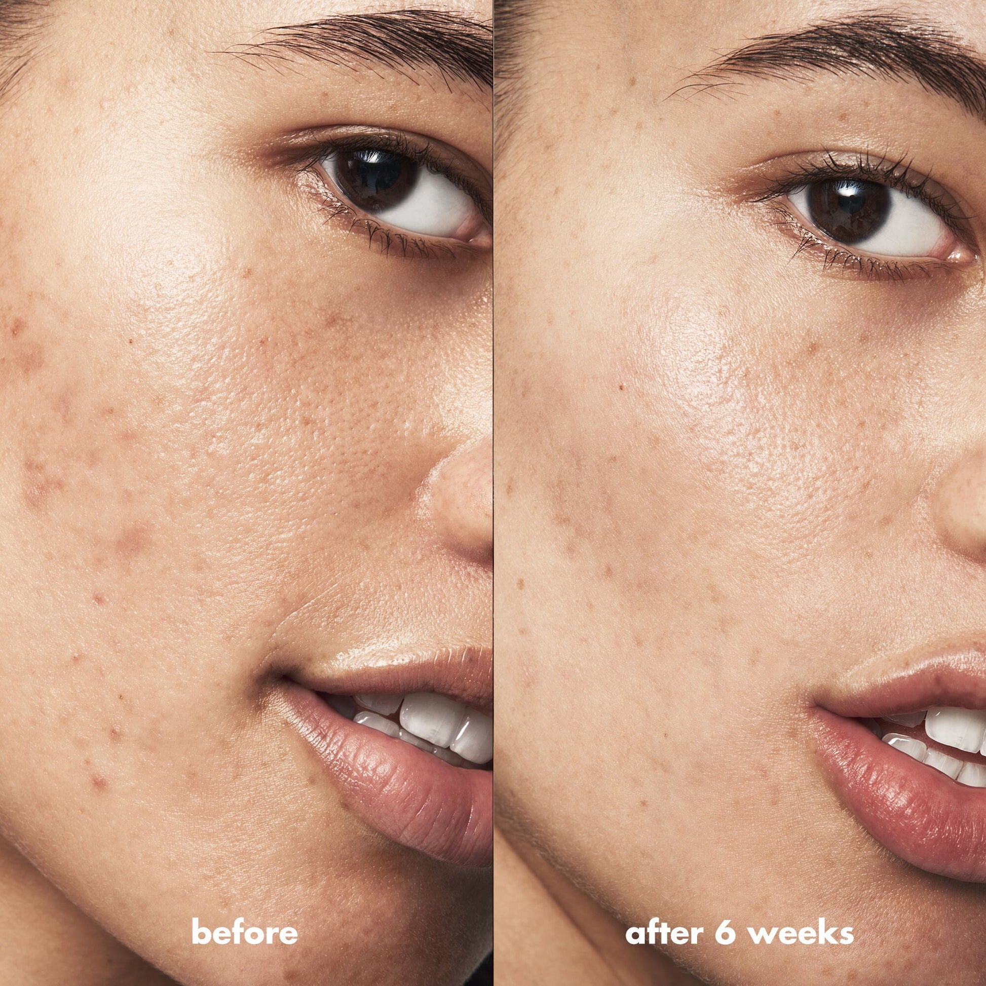 blemish-breakthrough-triple-acid-resurfacing-serum-s5 Acne_PDP_Isabella_Before_After_b8fe0505-ae5c-4baa-9a8e-fd889e4c3414.jpg