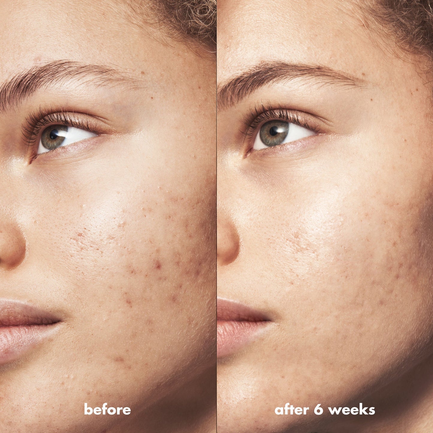 blemish-breakthrough-acne-calming-water-cream-a2 Acne_PDP_Marley_Before_After_be0f6ee7-ce12-4695-83d7-5ec5f0498e19.jpg